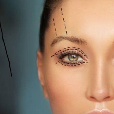 Eyelid Surgery for Thyroid Eye Disease