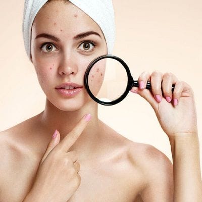 How Much Does an Acne Scar Treatment Cost in Dubai