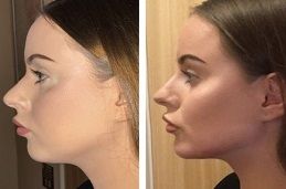 Jawnline FIller Injections