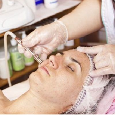 Microdermabrasion for Acne Before and After