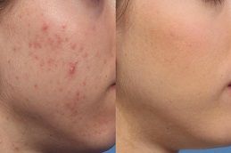 Microdermabrasion for Face Acne before & after in Dubai