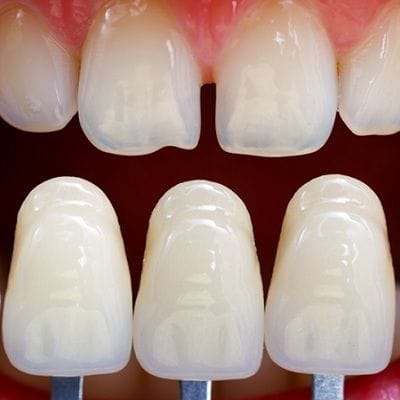 dental veneer in dubai