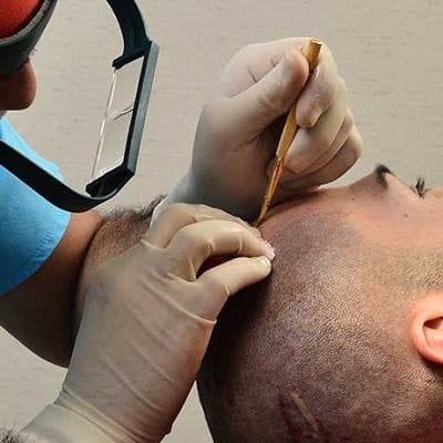 Hair Transplant Cost