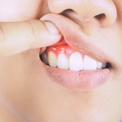 gum bleeding Treatment In Dubai
