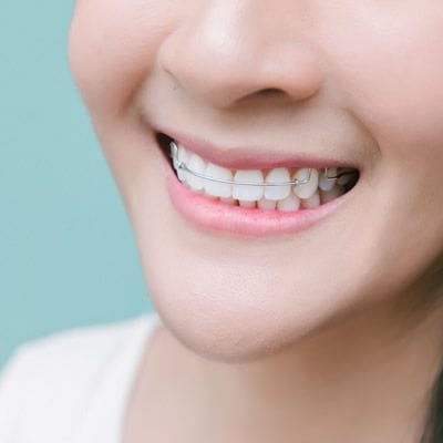 lingual braces in Dubai