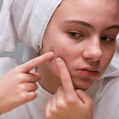 6 Ways To Say ‘Goodbye’ To Ugly Pimples With Dynamic Clinic Dubai