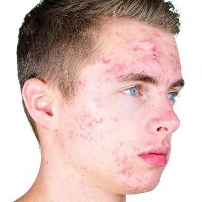 Acne In Men Causes Of Adult Acne, Prevention, Treatment & Cost