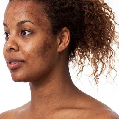 Acne Scar Treatment for Brown Skin