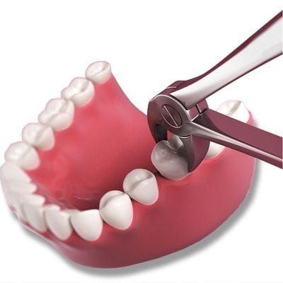 Cheapest Tooth Extraction in Dubai and Abu Dhabi