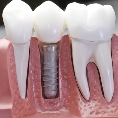 Dental Implants Price List