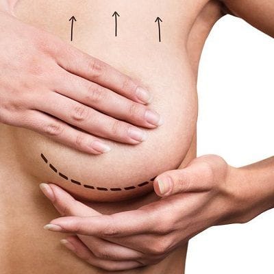 Do Breast Implant Costs More than Breast Lift?