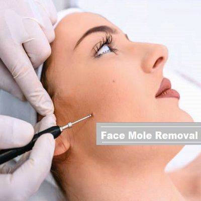 Facial Mole Removal Cost in Dubai