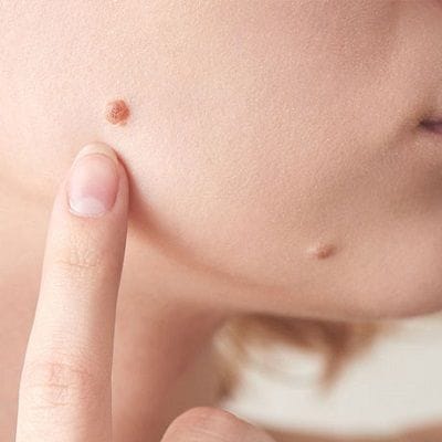 Flat Skin Tags On Face Removal In Dubai