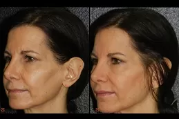 Jawline Fillers Injections Abu Dhabi