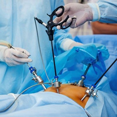 Laparoscopic Surgery Gallbladder Stone Removal Cost In Dubai