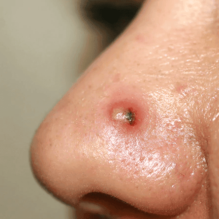 Nose Acne Scar Treatment in Dubai