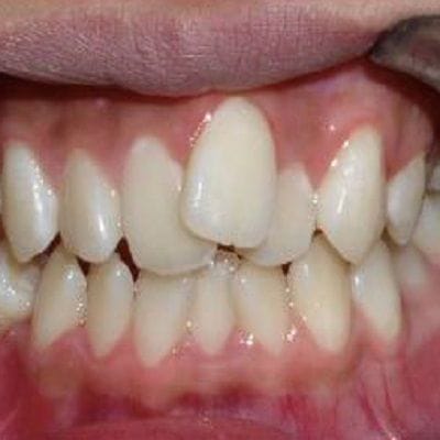 Overlapping Teeth Treatment Cost in Dubai