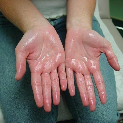Sweaty Hands and Feet Treatment