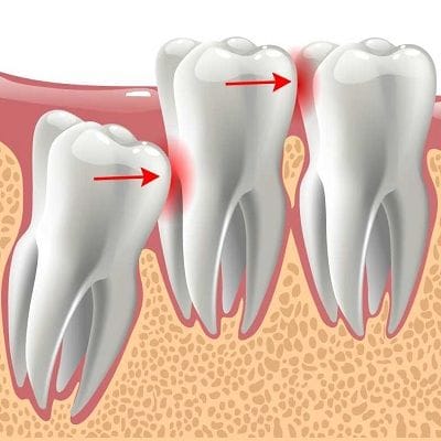 Wisdom Tooth Extraction in Dubai