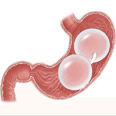 gastric balloon placement in dubai