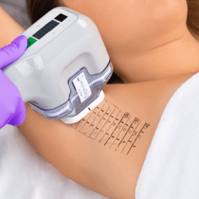 laser underarm treatment in dubai