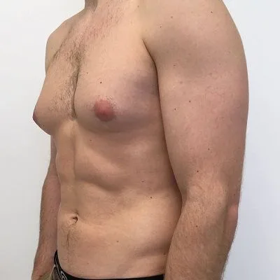 Gynecomastia Surgery