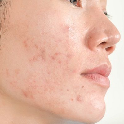 Fractional Laser For Acne Scars Cost In Dubai & Abu Dhabi