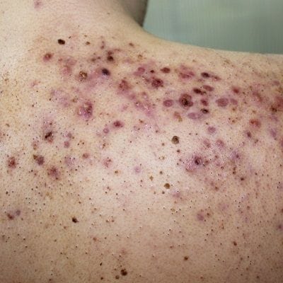What Is Acne Conglobata and How Is It Treated