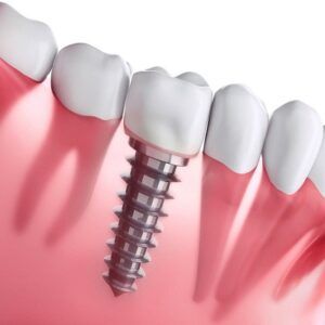 How Long Does Dental Implant Treatment Take
