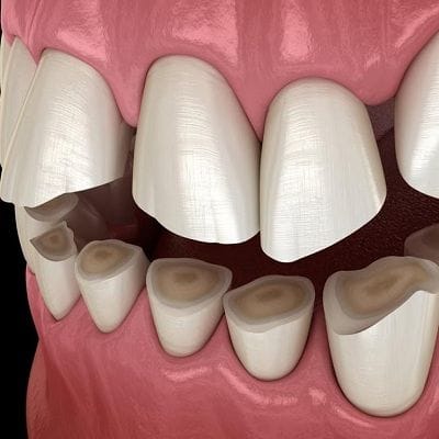 What Are The Causes of Teeth Grinding