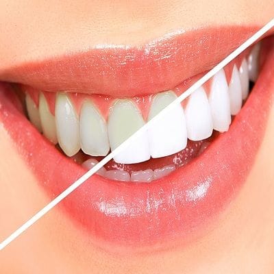 Can Hydrogen Peroxide Make Teeth Whiter?