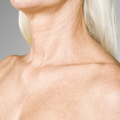 Botox to Treat Neck Wrinkles & Platysmal Bands In Dubai