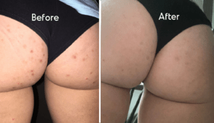 Butt acne removal in Dubai-Dynamic Clinic Dubai