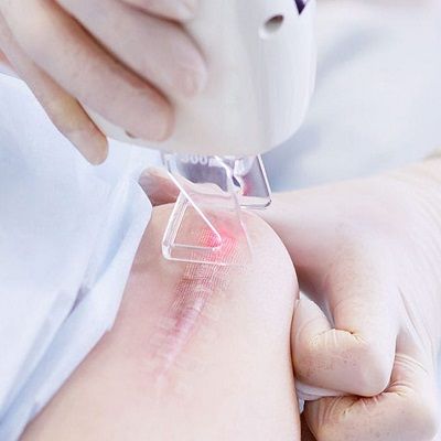 Can You Remove Surgery Scars With A Laser