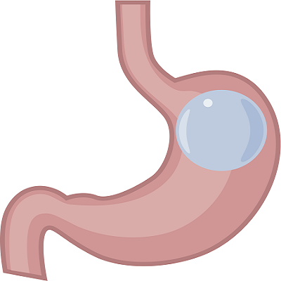 Removing the Gastric Balloon: What to Expect During and After?