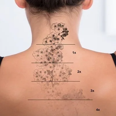 How Does Laser Tattoo Removal Work?
