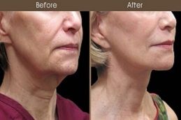 Neck lift and tightening in Dubai and Abu Dhabi