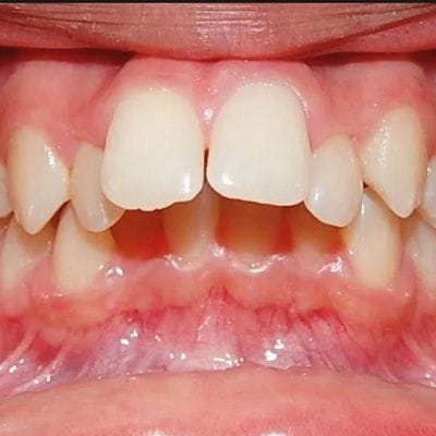 Protruding Teeth Treatment Cost in Dubai & Abu Dhabi