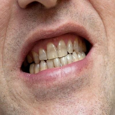 How To Remove Smoking Stains From Teeth