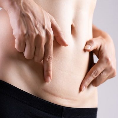 Tummy Tuck Scars Prevention,Treatment & Removal