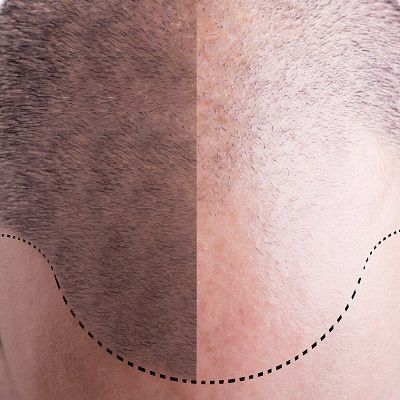 balding surgery cost in dubai