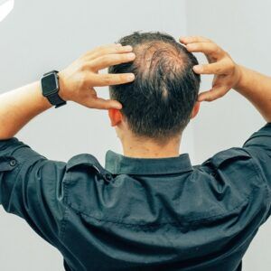 Are FUE Hair Transplants Painful in Dubai?
