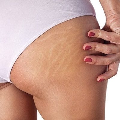 stretch marks removal treatment in Dubai