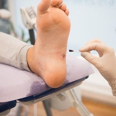 warts removal in Dubai