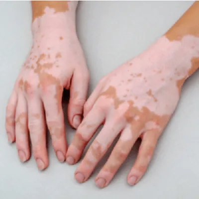 Autoimmune Skin Disease Treatment Options