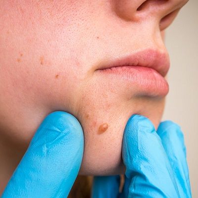 Facial Skin Lesions Removal Treatments in Dubai & Abu Dhabi