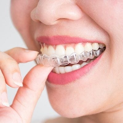 Fixed Braces Vs Aligners - Which One Is Better Choice?