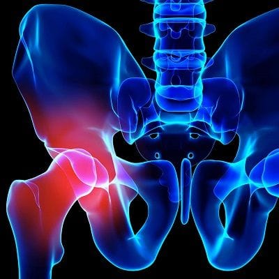 Hip Resurfacing For Women in Dubai, UAE - Cost & Deal