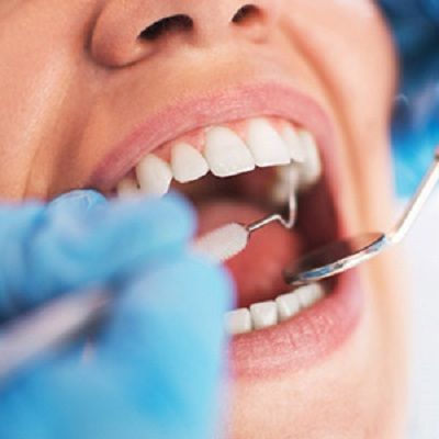 How Much Does a Cavity Filling Cost in Dubai - Price & Deals