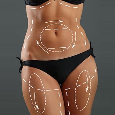 Is Dubai Good for the Liposuction Surgery - Dynamic Clinic